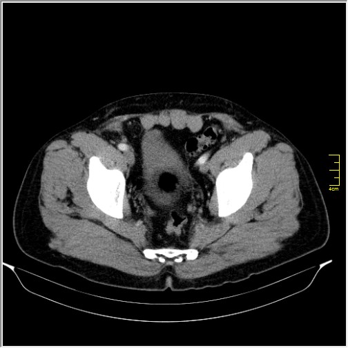 Acute right sided diverticulitis (Radiopaedia 65249-74268 Axial C+ portal venous phase 71).JPG