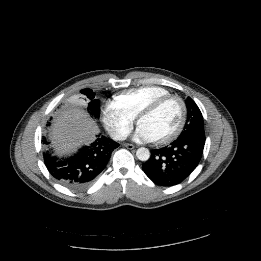 Acute segmental pulmonary emboli and pulmonary infarction (Radiopaedia 62264-70444 Axial C+ CTPA 78).jpg