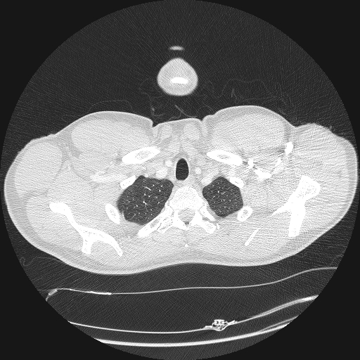 Acute segmental pulmonary emboli and pulmonary infarction (Radiopaedia 62264-70444 Axial lung window 10).jpg