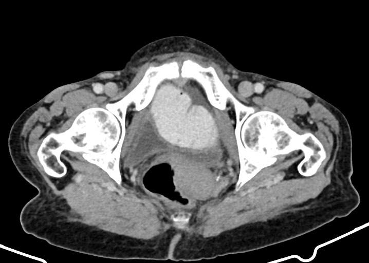Acute small bowel (ileal) volvulus (Radiopaedia 71740-82139 Axial C+ portal venous phase 188).jpg
