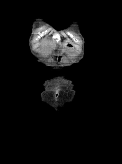 Acute small bowel (ileal) volvulus (Radiopaedia 71740-82139 Coronal C+ portal venous phase 7).jpg