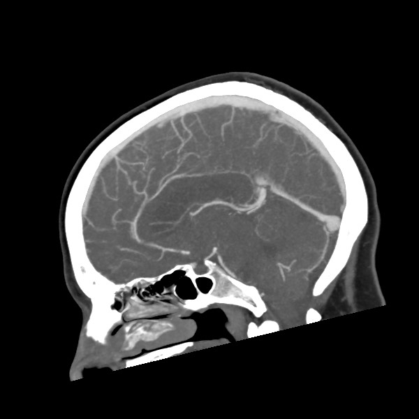 Acute subarachnoid hemorrhage and accessory anterior cerebral artery (Radiopaedia 69231-79009 Sagittal C+ arterial phase 36).jpg