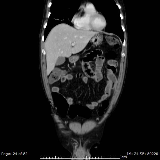 Acute superior mesenteric artery occlusion (Radiopaedia 43636-47060 Coronal C+ portal venous phase 9).jpg