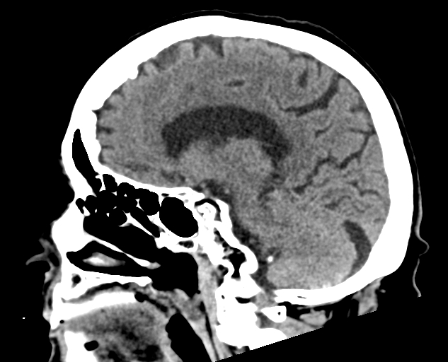 Acute traumatic subdural hematoma (Radiopaedia 82921-97257 Sagittal non-contrast 43).jpg