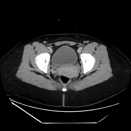 Acute uncomplicated appendicitis (Radiopaedia 73704-84499 Axial C+ portal venous phase 151).jpg