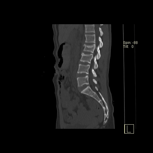 File:Acute vertebral compression fracture (Radiopaedia 63832-72559 Sagittal bone window 15).jpg