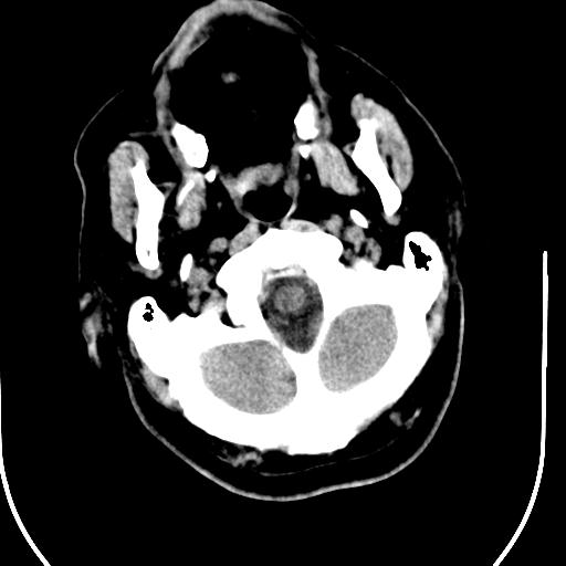 File:Acute vertebrobasilar ischemic infarction (Radiopaedia 25220-25473 Axial non-contrast 7).jpg