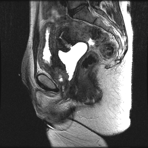File:Adenocarcinoma arising in a urethral diverticulum (Radiopaedia 12400-12657 Sagittal T2 3).jpg