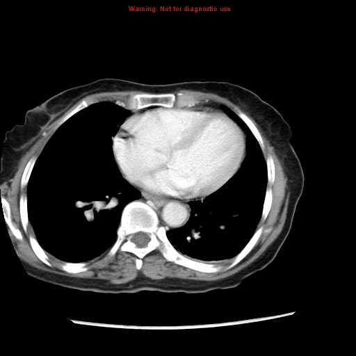 Adenocarcinoma of the colon (Radiopaedia 8191-9039 Axial liver window 2).jpg