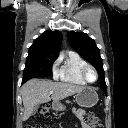 Adenocarcinoma of the lung (Radiopaedia 59871-67325 Coronal C+ arterial phase 16).jpg