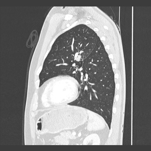 Adenocarcinoma of the lung (Radiopaedia 59871-67325 Sagittal lung window 74).jpg