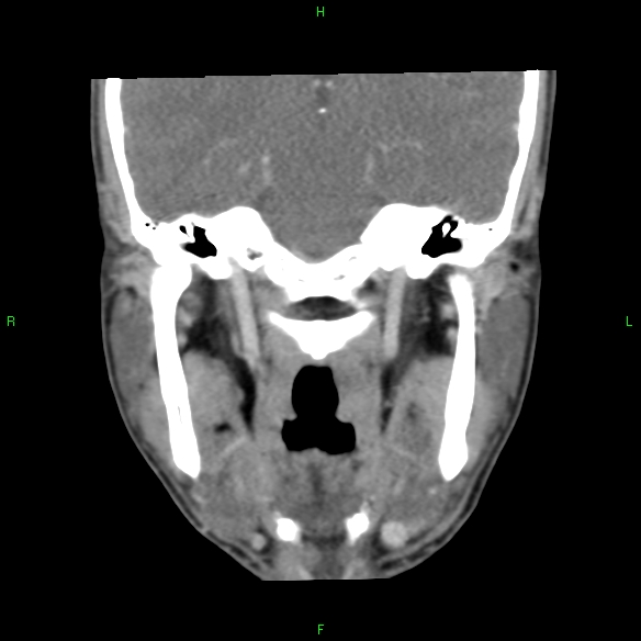 File:Adenoid cystic carcinoma of hard palate (Radiopaedia 26137-26273 Coronal liver window 22).jpg