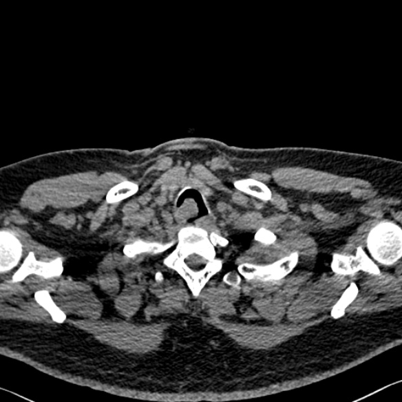 Adenoid cystic carcinoma of the trachea (Radiopaedia 49042-54137 Axial non-contrast 17).jpg
