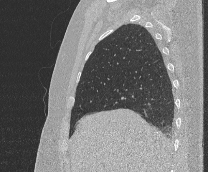 Adenoid cystic carcinoma of the trachea (Radiopaedia 49042-54137 Sagittal lung window 109).jpg