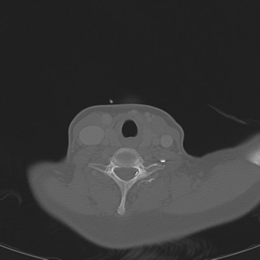 Adenoid cystic tumor of palate (Radiopaedia 46980-51518 Axial bone window 55).png