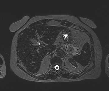 File:Adenomyomatosis of the gallbladder (Radiopaedia 50246-55587 Axial 83).png