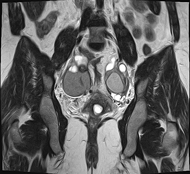 File:Adenomyosis - ovarian endometriomas (Radiopaedia 67031-76350 Coronal T2 18).jpg