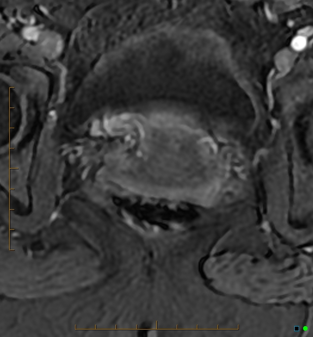 Adenomyosis uterus with hematometra (Radiopaedia 45779-50011 Axial T1 C+ fat sat 52).jpg