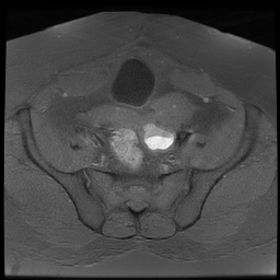 File:Adenomyosis within a didelphys uterus (Radiopaedia 70175-80215 Axial T1 fat sat 20).jpg