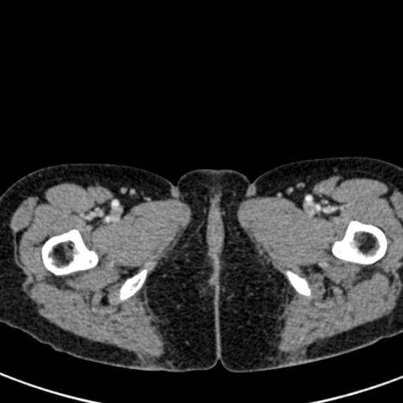 Adhesional small bowel obstruction (Radiopaedia 48397-53305 Axial C+ portal venous phase 104).jpg