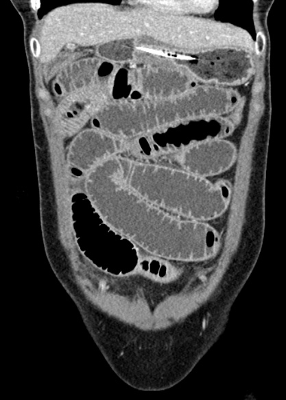 Adhesional small bowel obstruction (Radiopaedia 48397-53305 Coronal C+ portal venous phase 85).jpg