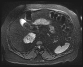 Adrenal cortical carcinoma (Radiopaedia 64017-72770 Axial DWI 56).jpg