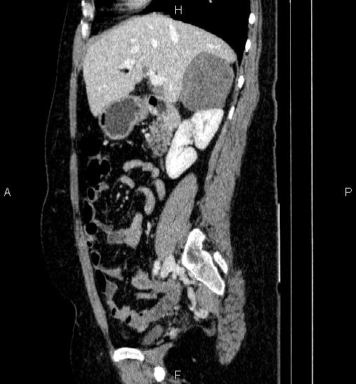 Adrenal cortical carcinoma (Radiopaedia 84882-100379 Sagittal C+ portal venous phase 33).jpg