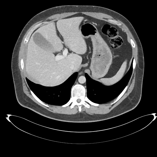 File:Adrenal cyst (Radiopaedia 45625-49778 AXIAL THICK 60 sec 5).png