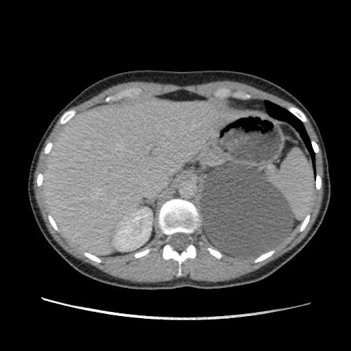 Adrenal cyst (Radiopaedia 64869-73813 Axial C+ portal venous phase 19).jpg