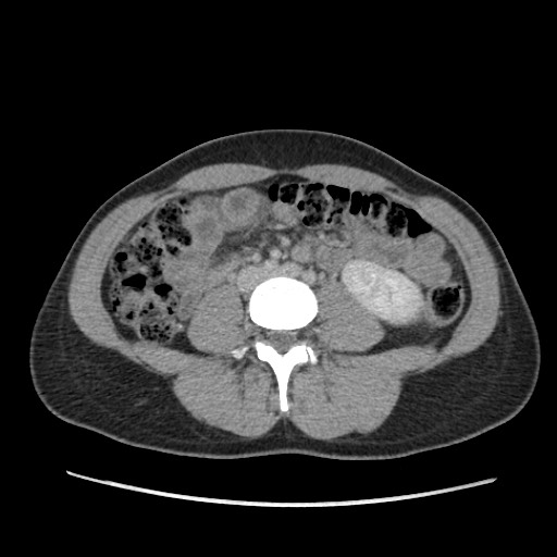 Adrenal cyst (Radiopaedia 64869-73813 Axial C+ portal venous phase 44).jpg