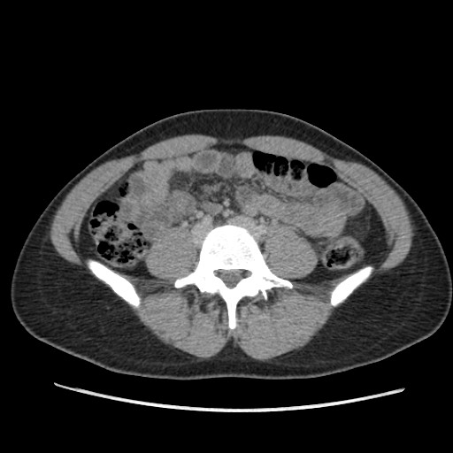 Adrenal cyst (Radiopaedia 64869-73813 Axial C+ portal venous phase 48).jpg