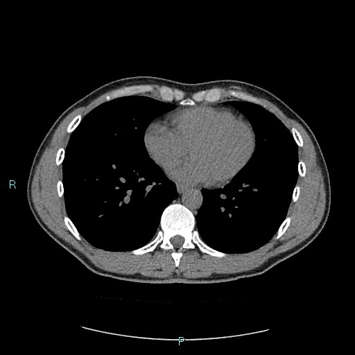 Adrenal cystic lymphangioma (Radiopaedia 83161-97534 Axial non-contrast 1).jpg