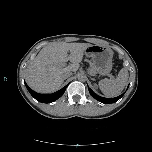 Adrenal cystic lymphangioma (Radiopaedia 83161-97534 Axial non-contrast 26).jpg
