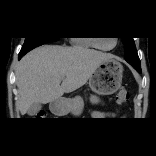 File:Adrenal gland trauma (Radiopaedia 81351-95079 Coronal non-contrast 28).jpg