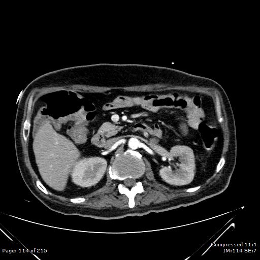 Adrenal metastasis (Radiopaedia 78425-91079 Axial C+ arterial phase 44).jpg