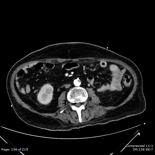File:Adrenal metastasis (Radiopaedia 78425-91079 Axial C+ arterial phase 66).jpg