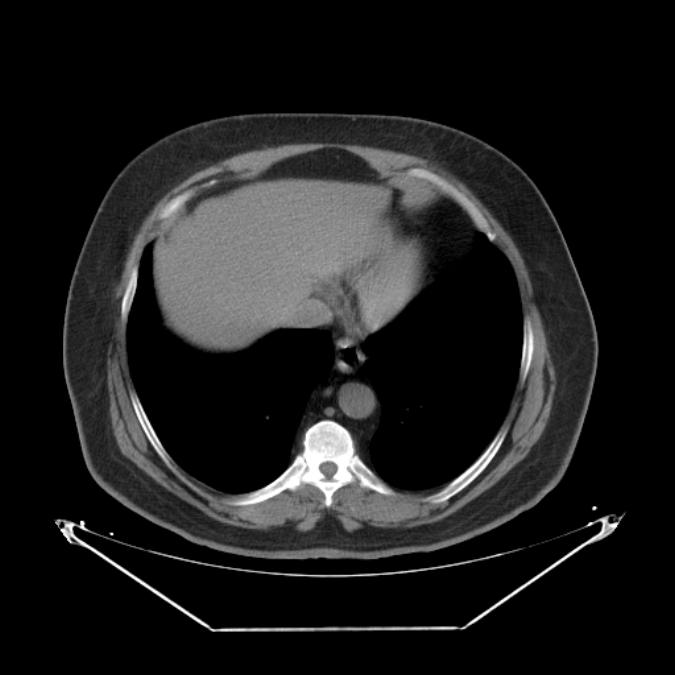 Adrenal myelolipoma (Radiopaedia 26278-26407 Axial non-contrast 2).jpg