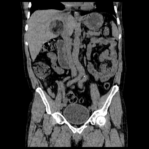 File:Adrenal myelolipoma (Radiopaedia 41843-44834 Coronal non-contrast 1).jpg