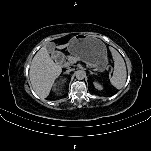 Adrenal myelolipoma (Radiopaedia 82742-96986 Axial non-contrast 42).jpg