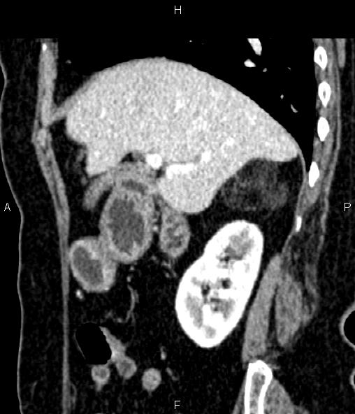 Adrenal myelolipoma (Radiopaedia 82742-96986 Sagittal renal cortical phase 38).jpg