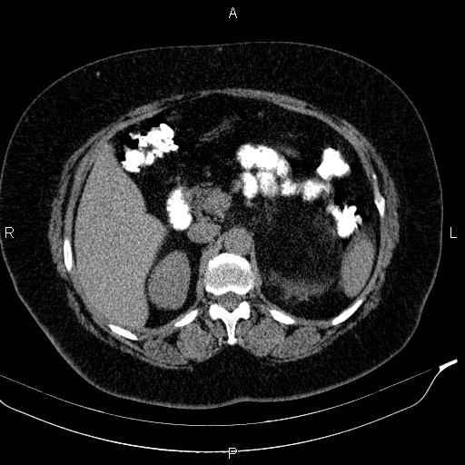 Adrenal myelolipoma (Radiopaedia 84319-99617 Axial With oral contrast 75).jpg