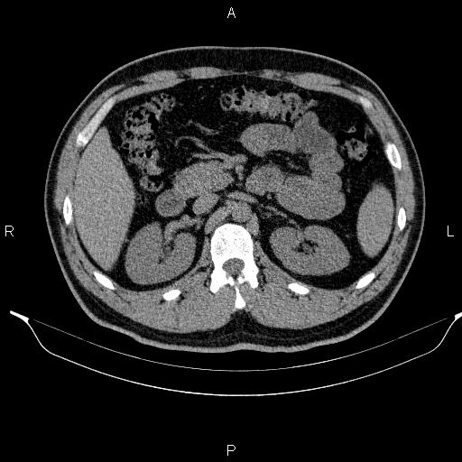 Adrenal myelolipoma (Radiopaedia 84321-99619 Axial non-contrast 42).jpg