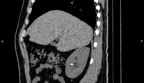 Adrenal myelolipoma (Radiopaedia 84321-99619 Sagittal non-contrast 30).jpg
