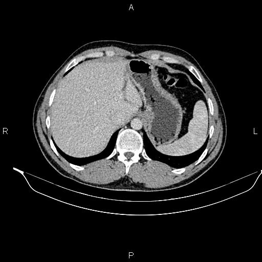 Adrenal myelolipoma (Radiopaedia 87794-104246 Axial renal cortical phase 20).jpg