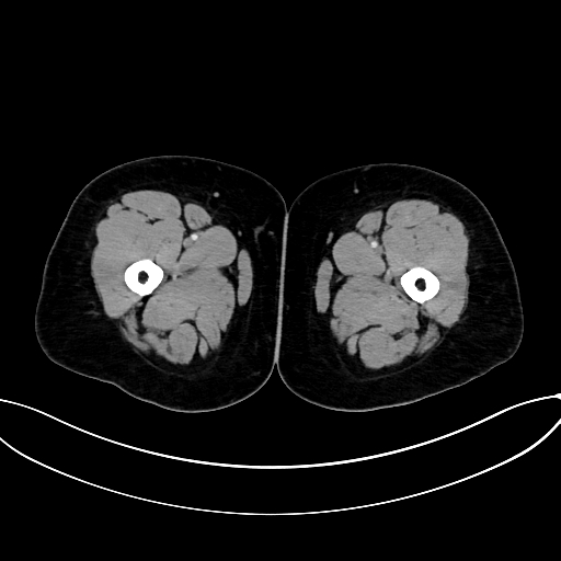 Adrenocortical carcinoma (Radiopaedia 87281-103569 Axial C+ portal venous phase 107).jpg