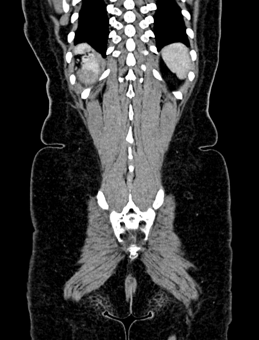 Adrenocortical carcinoma (Radiopaedia 87281-103569 Coronal C+ portal venous phase 137).jpg