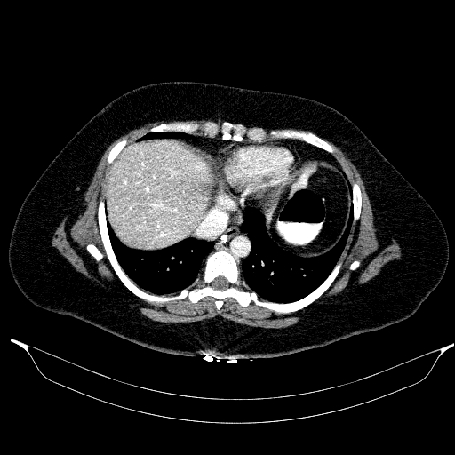 File:Afferent loop syndrome - secondary to incarcerated trocar site hernia (Radiopaedia 82959-97305 Axial C+ portal venous phase 24).jpg