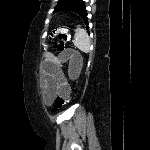 File:Afferent loop syndrome - secondary to incarcerated trocar site hernia (Radiopaedia 82959-97305 Sagittal C+ portal venous phase 25).jpg
