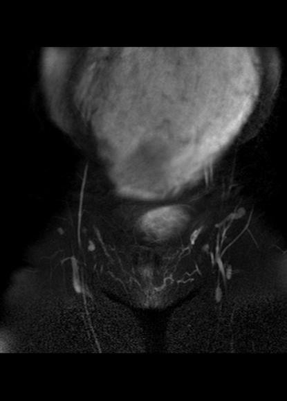 File:Aggressive angiomyxoma of the pelvis and perineum (Radiopaedia 59162-66479 Coronal T2 fat sat 3).jpg