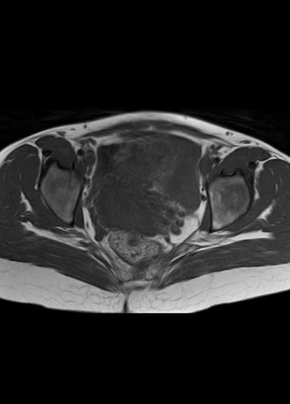 File:Aggressive angiomyxoma of the pelvis and perineum (Radiopaedia 59162-66479 T1 13).jpg